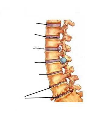 Ako sa vyvíja osteochondróza