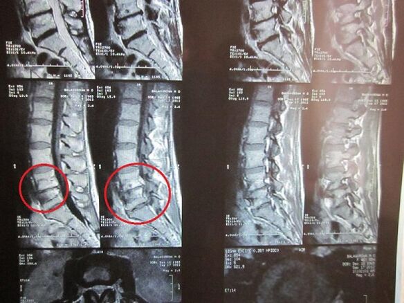 Diagnostika krčnej osteochondrózy