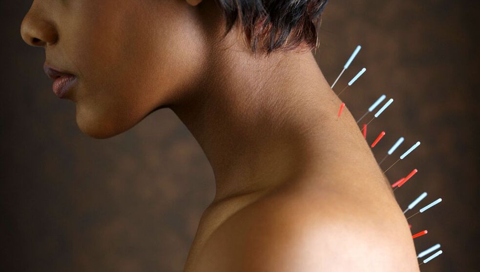 akupunktúra s cervikálnou osteochondrózou