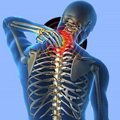 bolesť krku s cervikálnou osteochondrózou