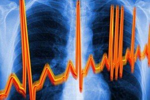 srdcová arytmia pre osteochondrózu