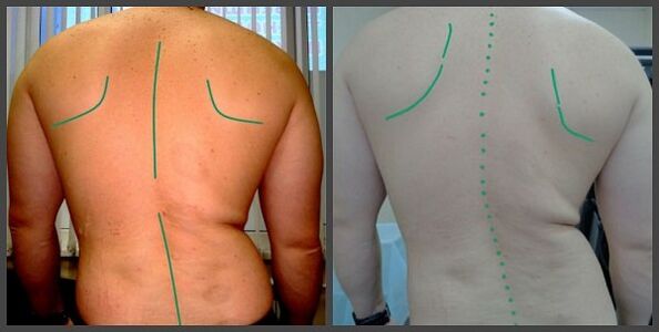 zakrivenie chrbtice s osteochondrózou