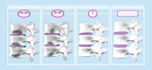 Štádiá krčnej osteochondrózy