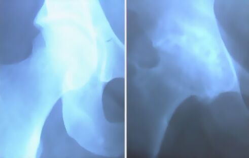 Spodina artrózy kolenného kĺbu