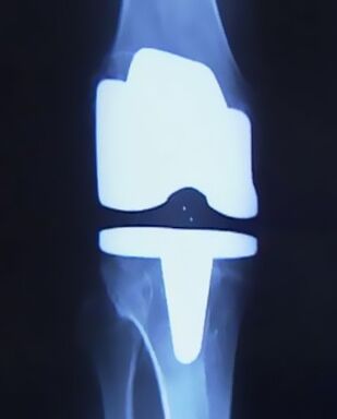 X -ray obrázok kolena s umelou protézou po operácii, aby sa zmenil kĺb