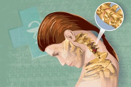 Reflexné príznaky osteochondrózy